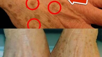 La meilleure vitamine pour éliminer les taches de vieillesse