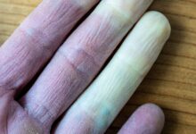 Pourquoi les doigts changent-ils de couleur ?