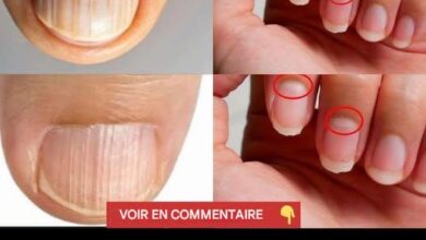 Des ongles ondulés révèlent les secrets d’une possible maladie